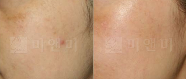 [시술전후사진]레이저토닝시술전후