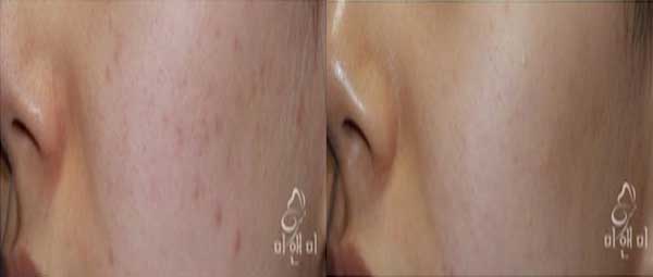 [시술전후사진]여드름치료-모자이크시술전후