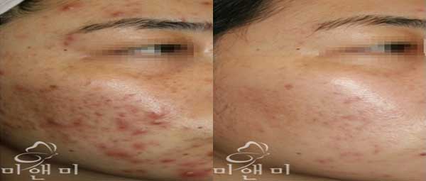 [시술전후사진]mts 시술전후