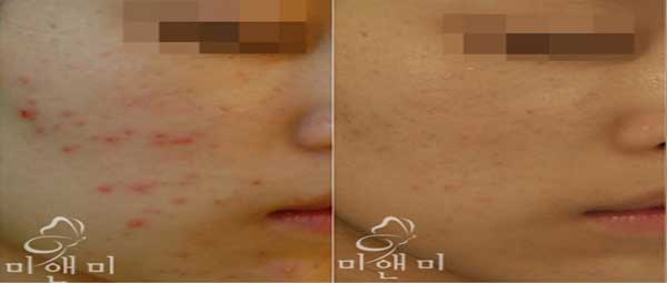 스킨스케일링_면포성 좁쌀여드름 시술전후사진