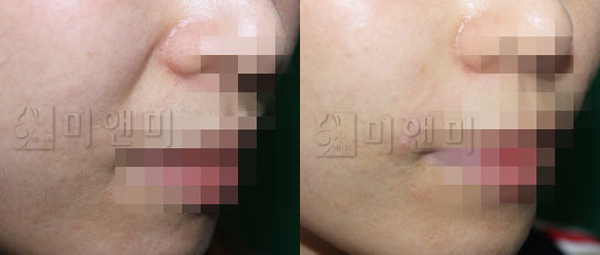 탄력을 잃은 팔자주름 실리프팅