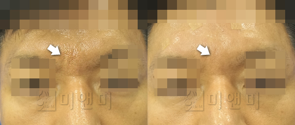 보기싫은 미간주름 필러로 채우기