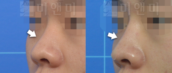 코필러 시술전후