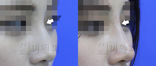코필러로 낮은코, 매부리코 교정